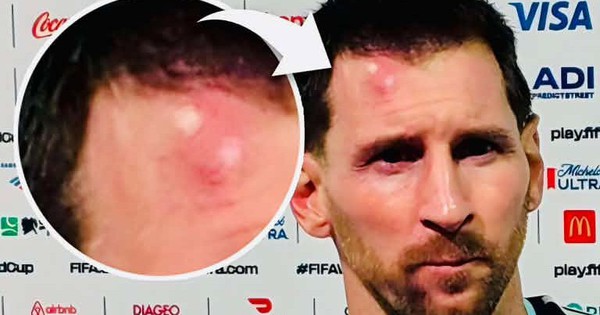 Messi sưng vêu trán sau trận thắng Cabo Verde: Chấn thương nhỏ không ngăn siêu sao tỏa sáng - hình ảnh - 789betjl.com